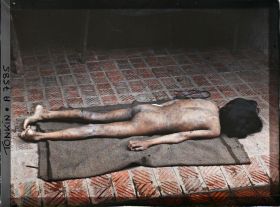 Image représentant Un enfant atteint de pian, couché sur le ventre à l'hôpital d'Hà-nôi